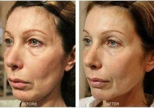 Before After Skin Tightening Treatment