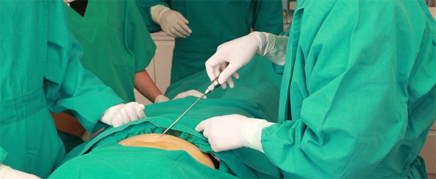 Male Liposuction Surgery | Liposuction for Men