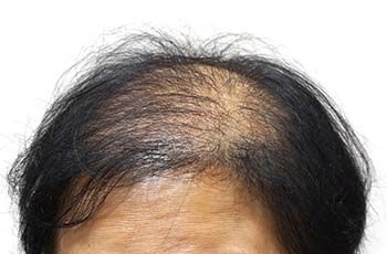 fue hair transplant for women