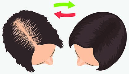 Result of FUE Hair Transplant for Women