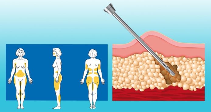 liposuction treatment to remove cellulite