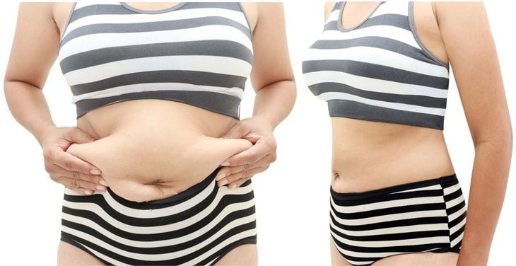 vaser-liposuction