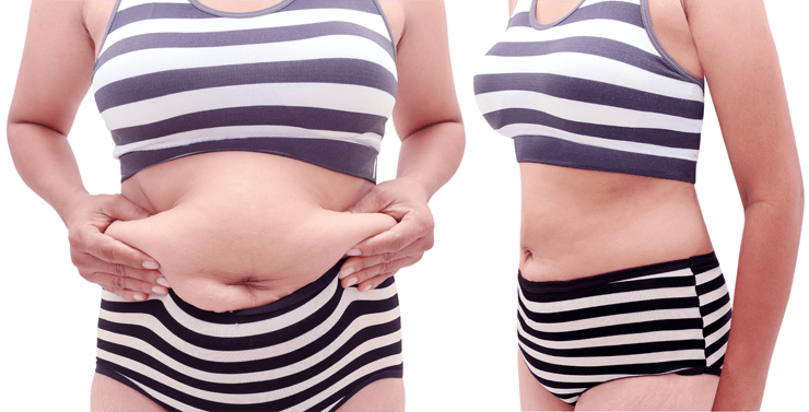 vaser-liposuction