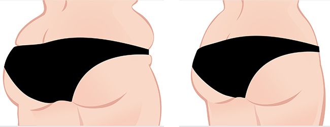 Buttock Lift Surgery