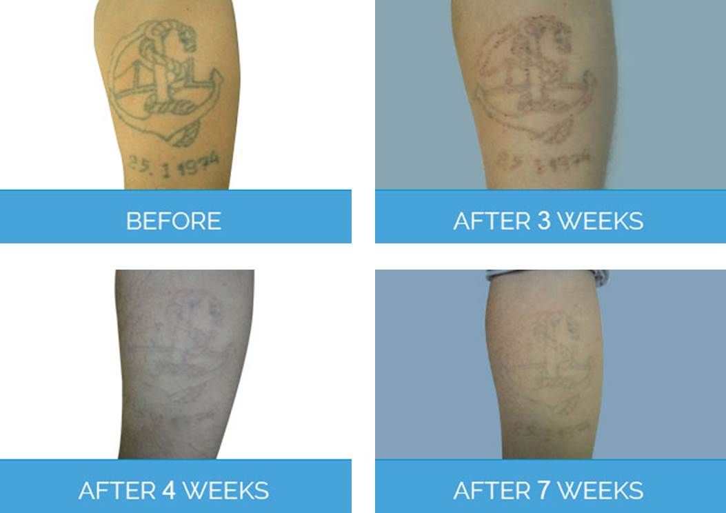 Laser Tattoo Removal before & after 