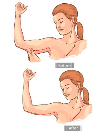 arm lift surgery