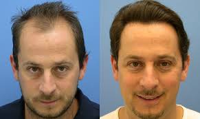 before-after-hair-transplant