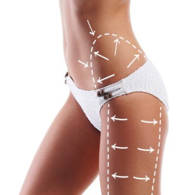 Liposuction