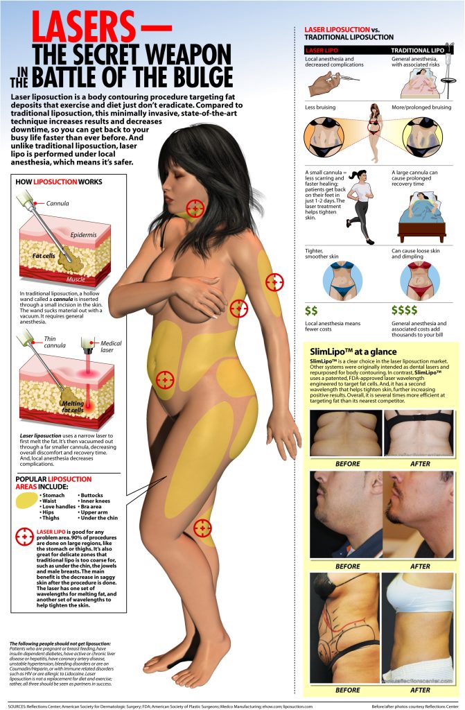 how-laser-liposuction-works