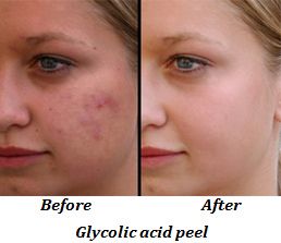 Chemical Peel - Skin Treatment