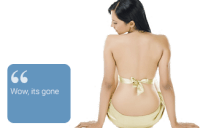 laser tattoo removal
