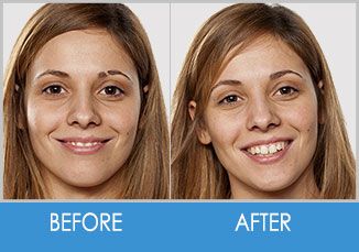 Eyebrow Restoration Before and After