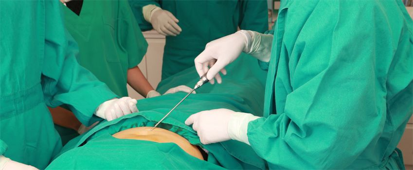 Male Liposuction Surgery