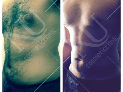 Vaser Before and After