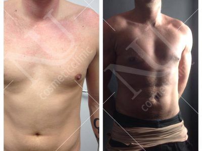 Vaser Before and After