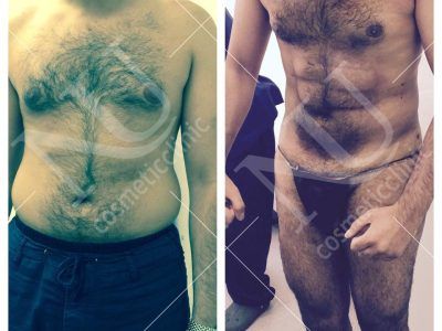 Vaser Before and After