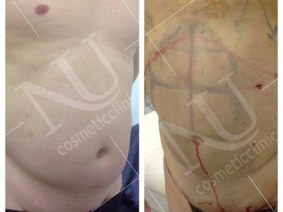 Vaser Before and After