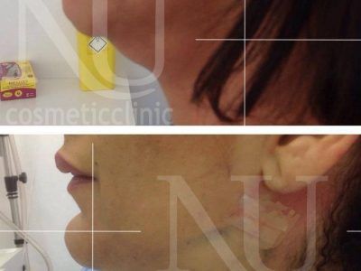 Face and Neck Before and After
