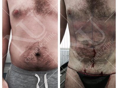 Vaser Before and After