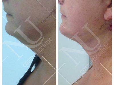 Face and Neck Before and After