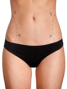 liposuction treatment without surgery