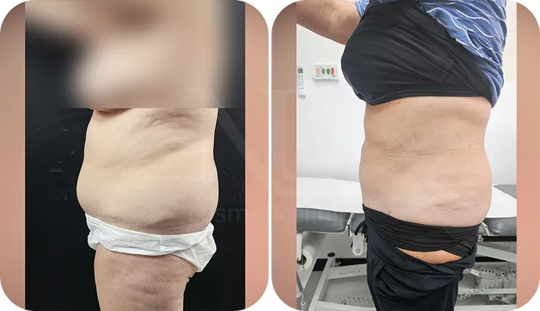 abdomen and flanks vaser liposuction patient before and after result-1