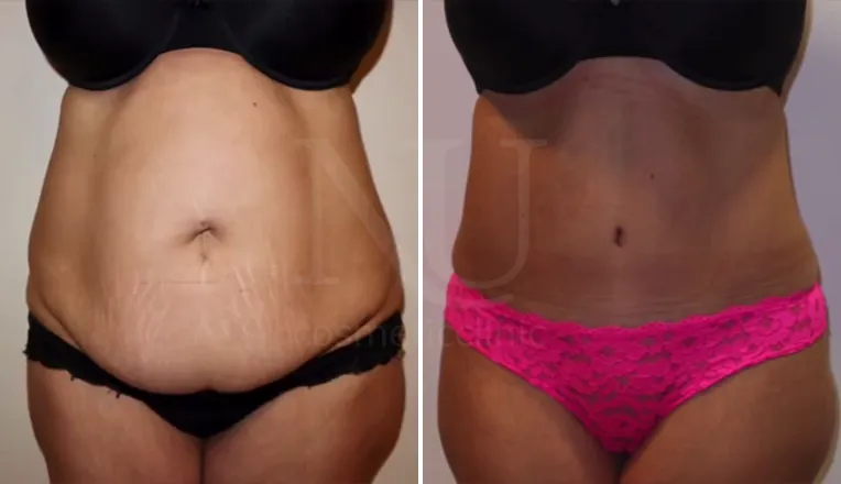 abdominoplasty patient before and after result-1