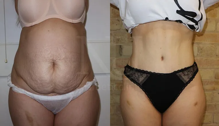 abdominoplasty patient before and after result