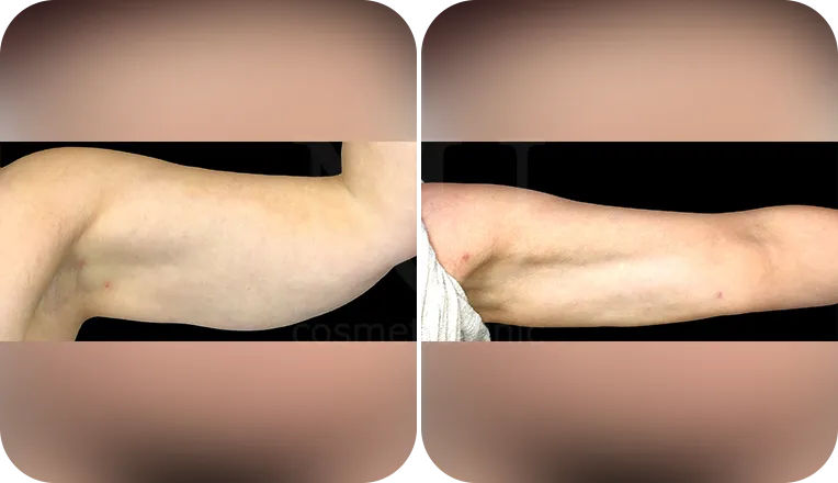arm vaser lipo before and after patient result-1
