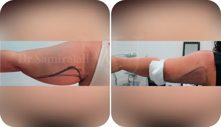 arm vaser lipo before and after patient result-2