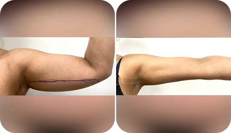arm vaser lipo before and after patient result