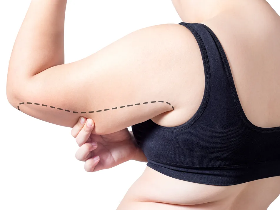 arm vaser liposuction