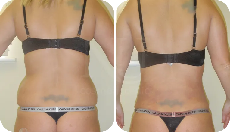 back vaser liposuction patient before and after result