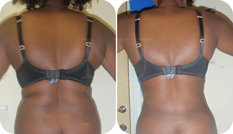 back vaser liposuction patient before and after result-2