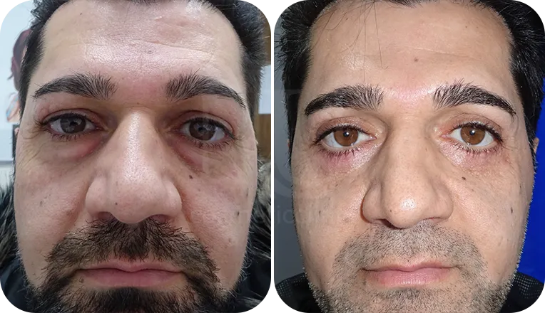 blepharoplasty patient before and after result-1-v1