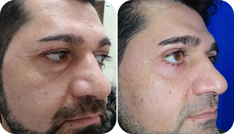 blepharoplasty patient before and after result-1-v2