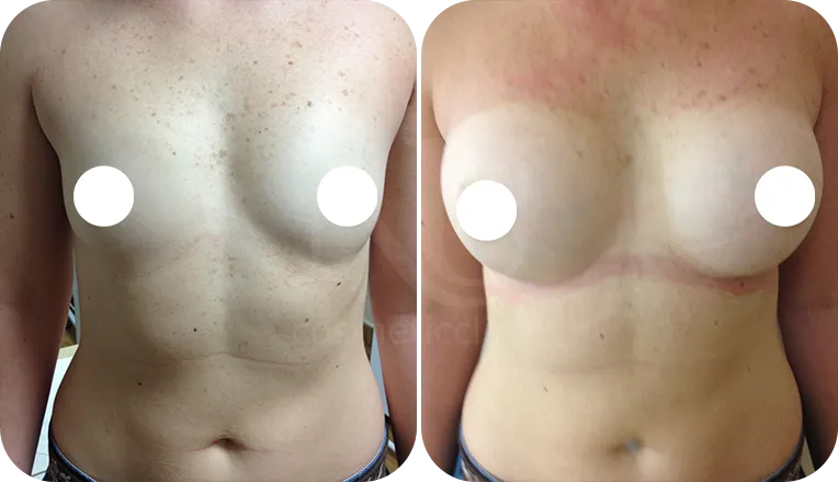 boob job patient before and after result-1