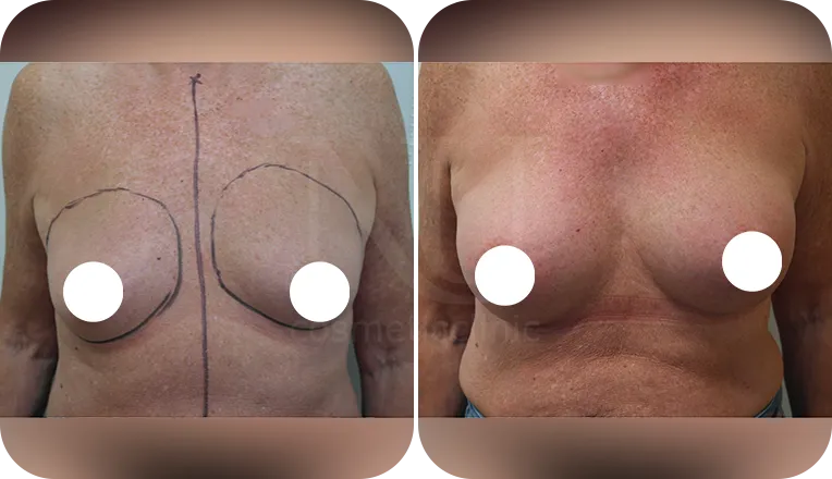 boob job patient before and after result-2