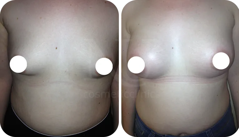 boob job patient before and after result-3