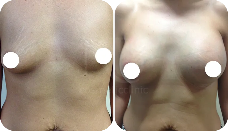 boob job patient before and after result