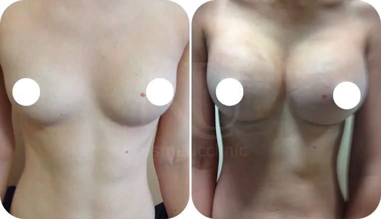 breast augmentation patient before and after result-1