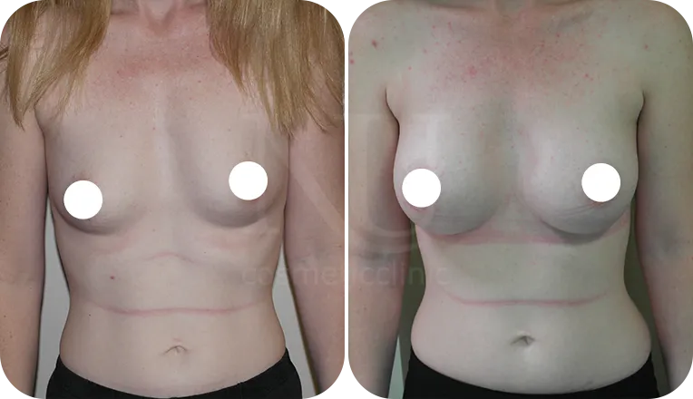 breast augmentation patient before and after result-2