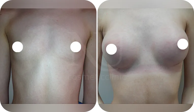 breast augmentation patient before and after result-3