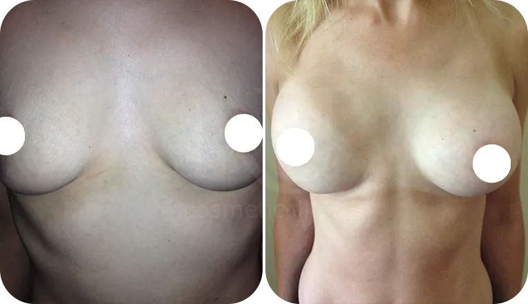 breast augmentation patient before and after result