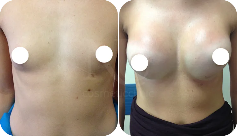 breast enlargement patient before and after result-1