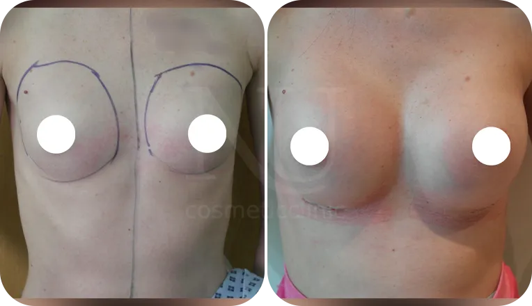breast enlargement patient before and after result-2