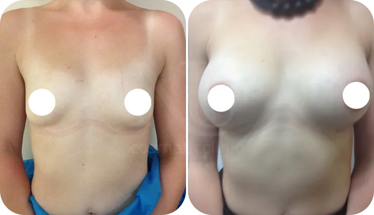 breast enlargement patient before and after result-3