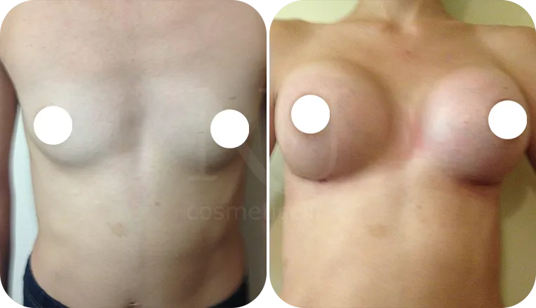 breast enlargement patient before and after result-4