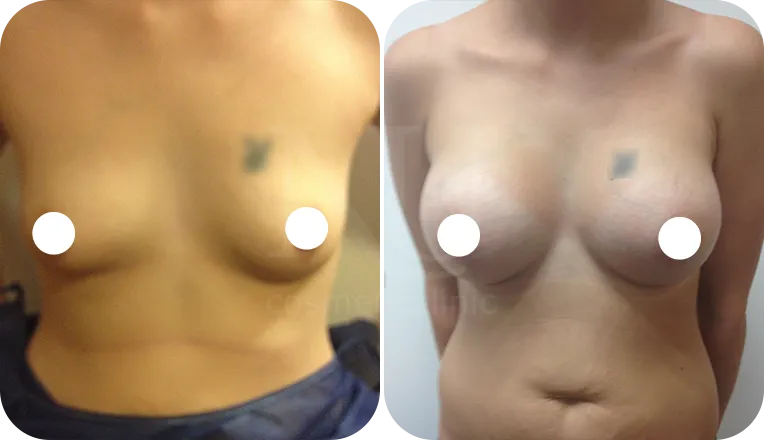 breast enlargement patient before and after result