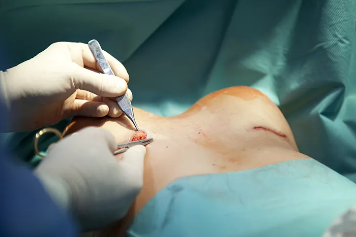 breast enlargement surgery procedure
